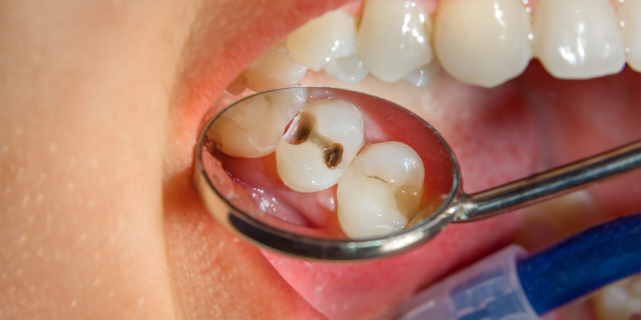What is teeth decay?