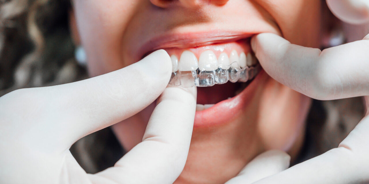 Benefits of Invisalign Vs Regular Braces: Eating, Drinking, and Special Occasions