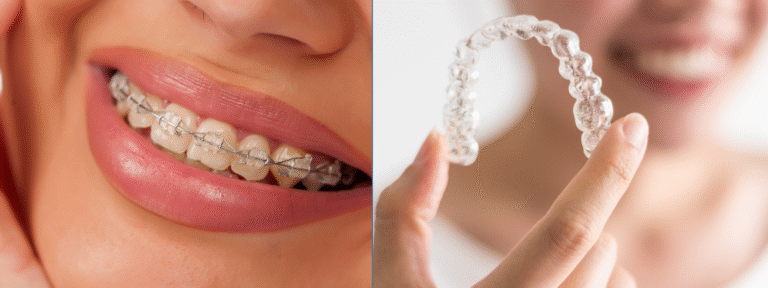 dental crowns-purple dental (4)