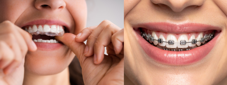 Dental Aligners vs Braces-pupel dental