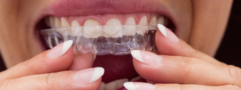 dental crowns-purple dental (7)