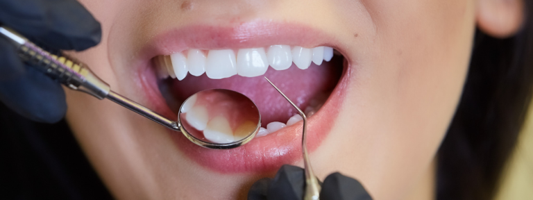 dental crowns-purple dental (11)